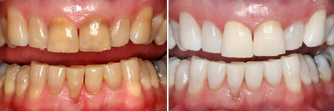 Arlington, VA teeth whitening dentist