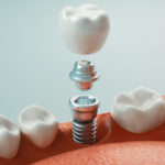 dental implant in arlignton va