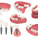 Technical drawings of dental implants: single, bridge, and dentures to replace missing teeth