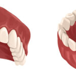 Illustration of dental bridges to replace missing teeth