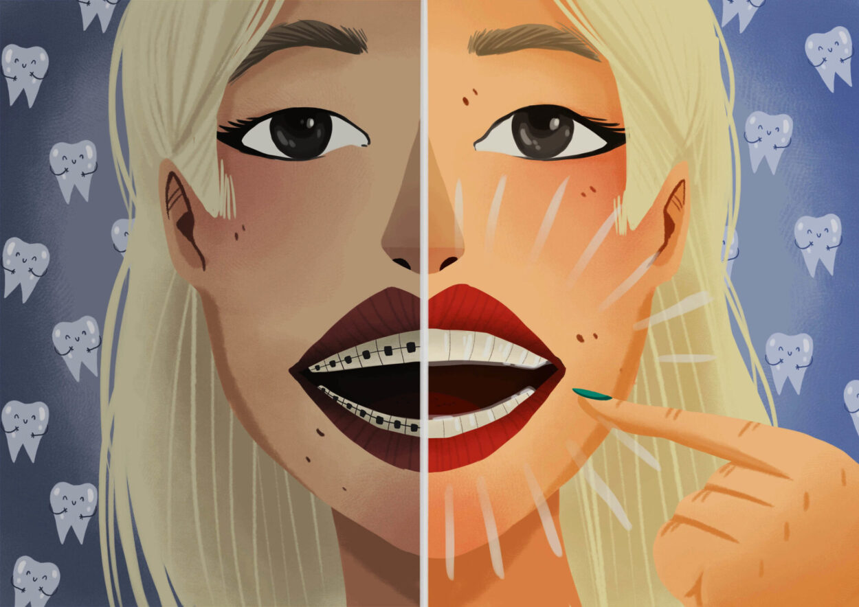 Illustration of a blond woman wearing braces on half her smile and Invisalign on the other half as an imaginary comparison