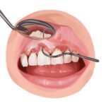 Illustration of a mouth with gum disease getting a deep cleaning at the dentist