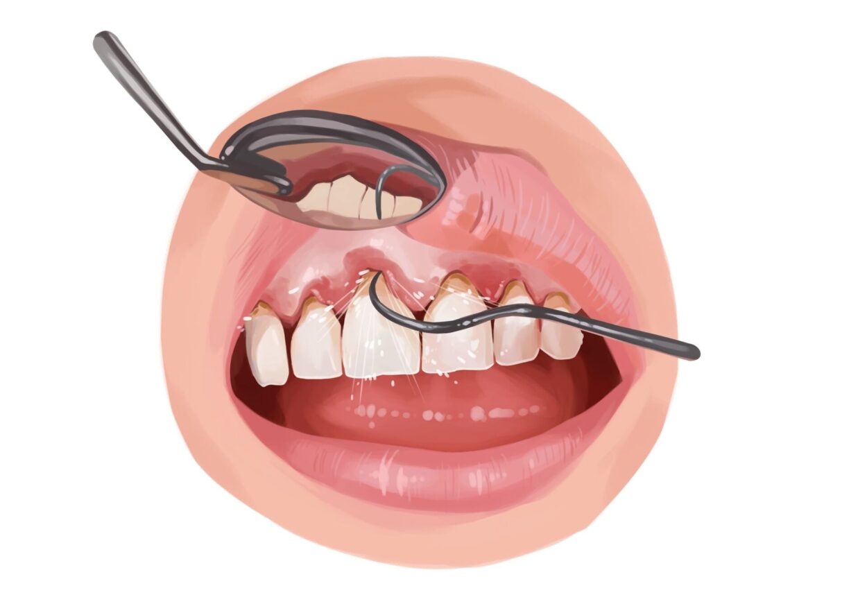 Illustration of a mouth with gum disease getting a deep cleaning at the dentist