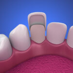 Dental Veneers: Porcelain Veneer installation Procedure. 3D illustration